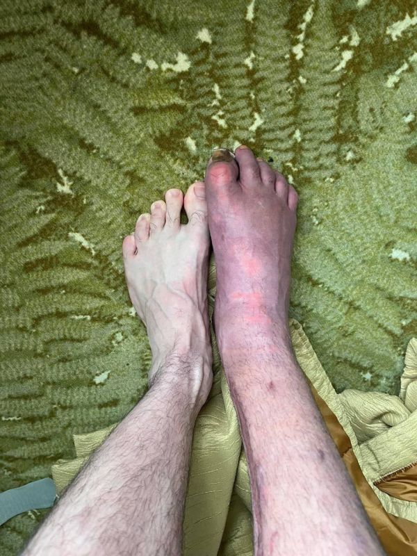 Инвалид ВСУ добивается увольнения главы МСЕК, Харьковской области