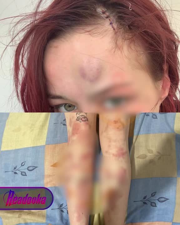 В Одессе военком избил девушку металлическими костылями за то, что она «посмела» снимать могилизацию своего парня на телефон